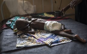 A young child suffering from severe malnutrition lies on a bed in the ICU ward at the In-Patient Therapeutic Feeding Centre in the Gwangwe district of Maiduguri, the capital of Borno State, northeastern Nigeria.