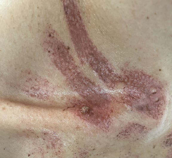 A Wellington woman has been left with burn marks all over her chest from an IPL treatment on 8 February 2024 (for use with this story ONLY).