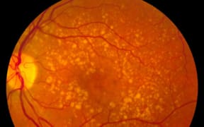 Intermediate_age_related_macular_degeneration