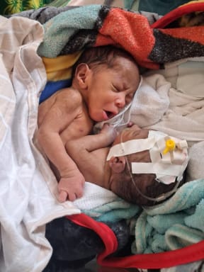 The twins are set to be brought to Sydney by a group that helped bring conjoined girls to Australia in 1996. (Supplied: Dr Kovei Umba)