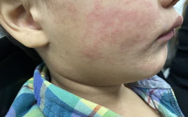 New measles case in Wellington - Health NZ | RNZ