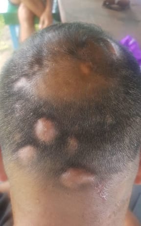 Abscesses from poorly controlled diabetes and rampant sepsis. Manus Island refugee, 2018.