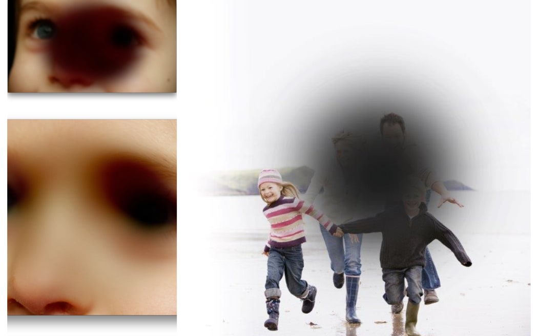 Aged Related Macular Degeneration