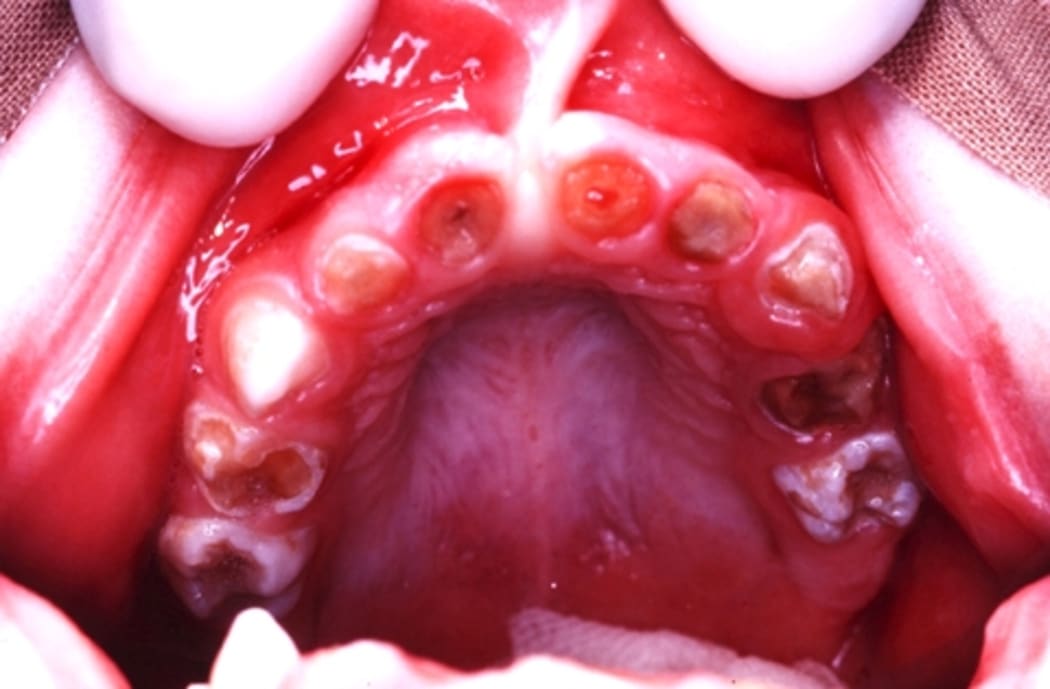 Tooth decay in a five-year-old child.