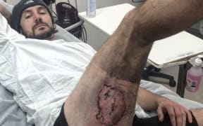 Cyclist Gareth Clear's leg was seriously burned after his iPhone caught fire in his pocket.