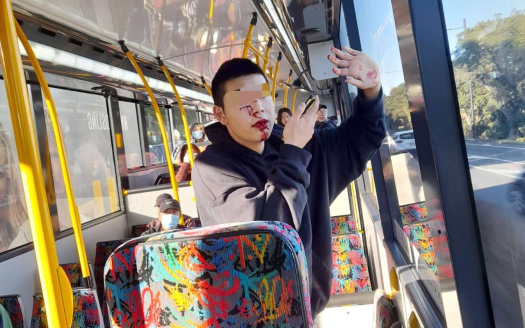 An Auckland teenager suffered severe facial injuries after being attacked by an unknown woman on a bus on 28 June 2024. SINGLE USE ONLY