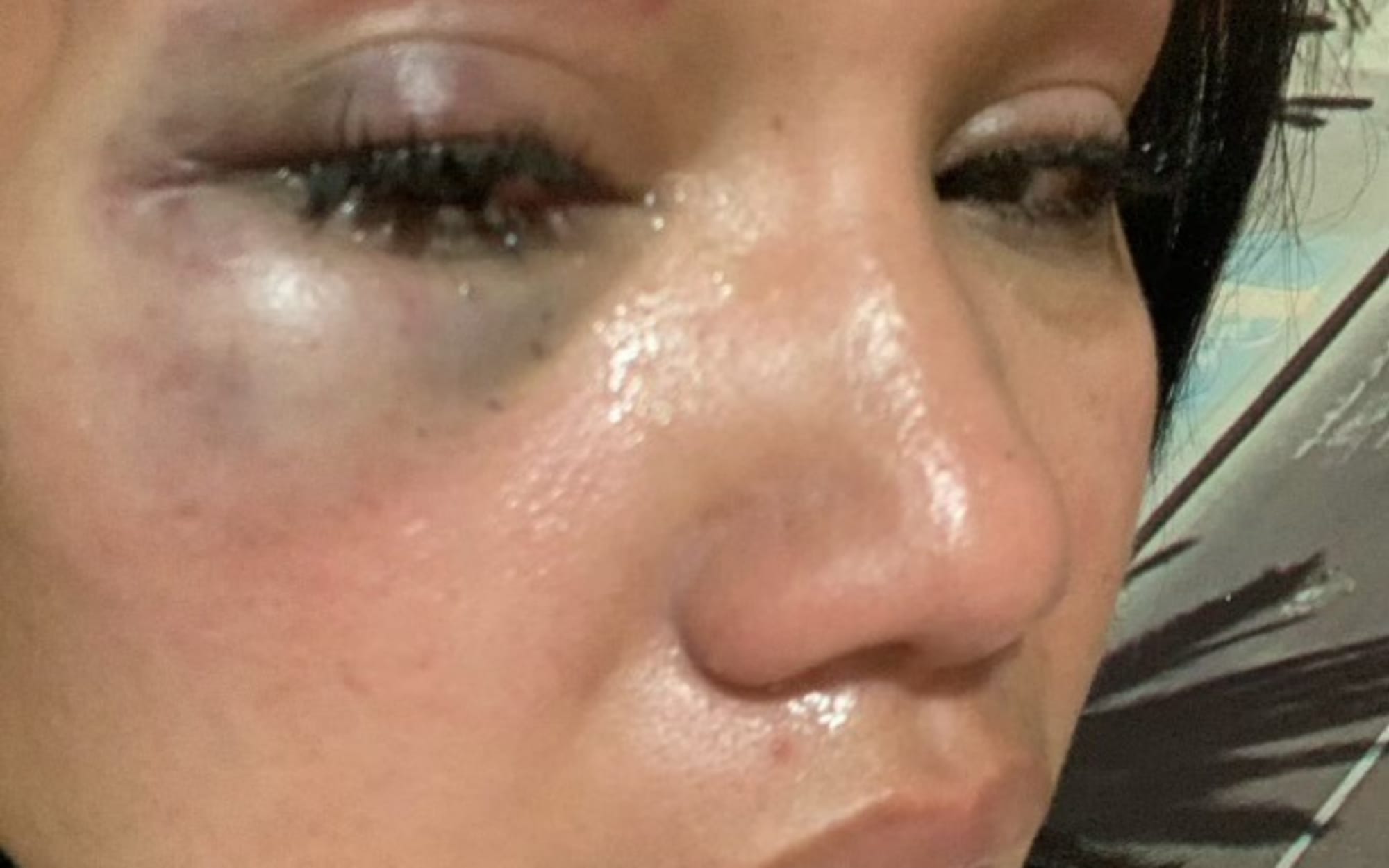 Injuries Yuliana Desta says were caused by her former partner, ex-All Black Byron Kelleher, in an assault she alleges happened in a Barcelona hotel in 2019.