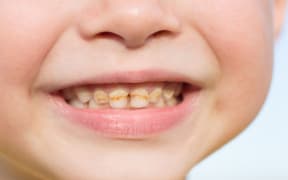 Close up child caries