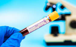 Prostate-specific antigen (PSA) blood test. Prostate cancer marker. Evaluates PSA levels, elevated in prostate cancer, used for screening and monitoring treatment response. (Photo by Wladimir Bulgar/Science Photo Li / WBU / Science Photo Library via AFP)