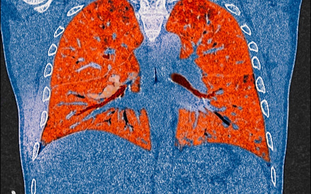 A CT scan of lungs showing the effects of Covid-19.