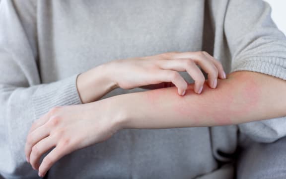 Stock image of a person scratching their arm.