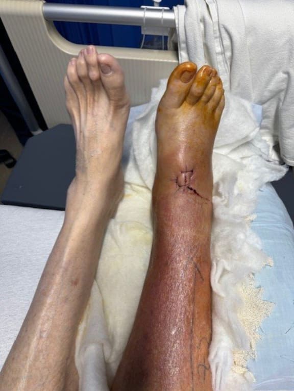 Palmerston North real estate agent Andy Stewart is still in hospital more than a month after suffering a white-tail spider bite.  The infection travelled down Andy Stewart's leg and he had to have an operation on his foot.
March 19, 2024 
Photo / Supplied