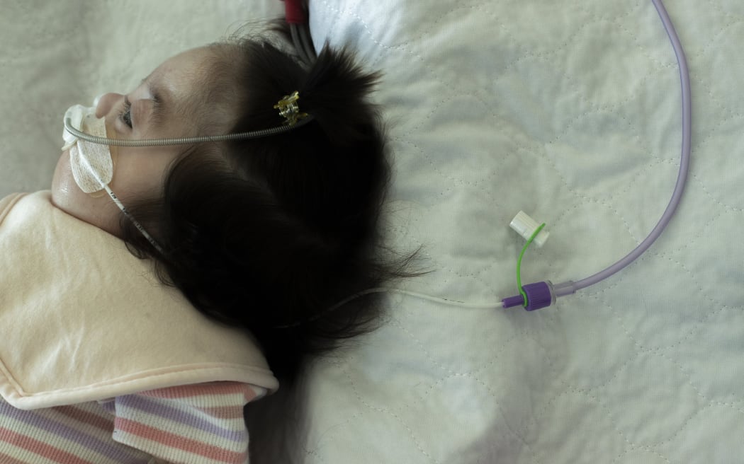 Luca has to be fed through a tube as she is unable to breast or bottle-feed.