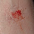 Lamprey bite