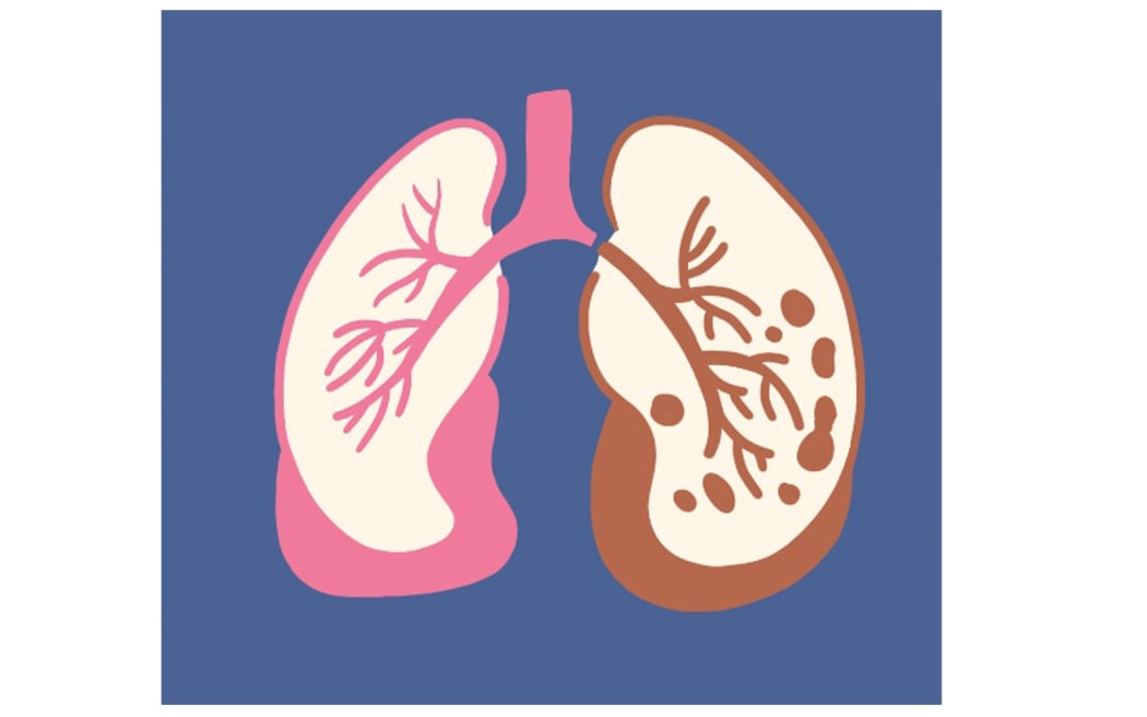 Healthy and unhealthy lungs