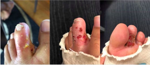 Waka ama paddlers who train on the river say they have been getting infections from the rivers.