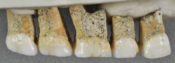 The right upper teeth of the individual CCH6 of the newly discovered species Homo luzonensis. From left are two premolars and 3 molars.
