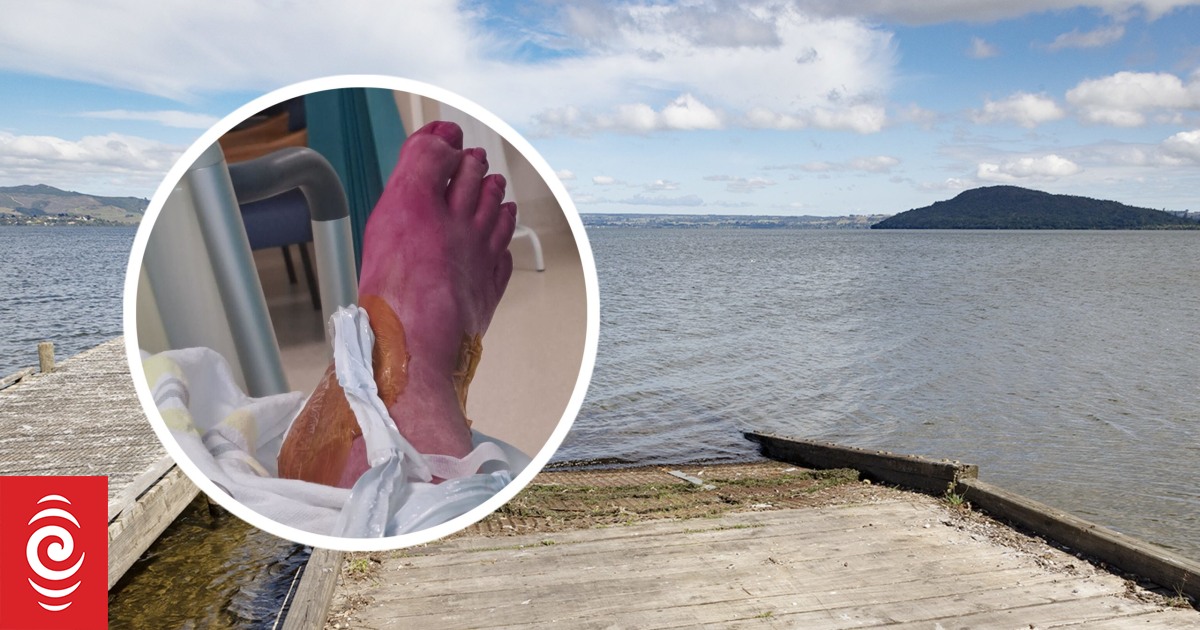 Rotorua boatie hospitalised after being injured on public boat ramp - Vimarsana News