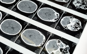 brain scans