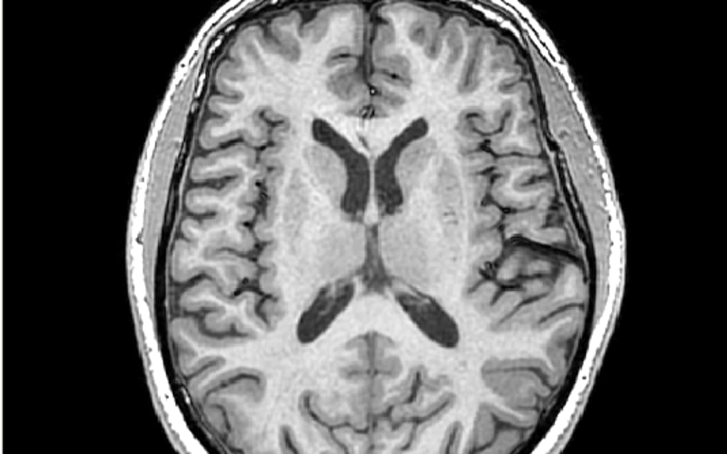 This is a high resolution, anatomical magnetic resonance image of the brain, which gives researchers exquisite detail about the structure of the brain, including the amount of grey matter tissue, white matter tissue, and cerebral spinal fluid.