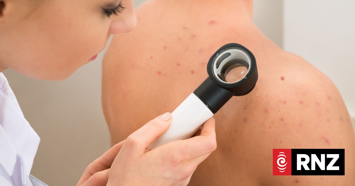 'The type of treatment we're looking for': Worldwide cancer trial shows promise in treatment of melanoma