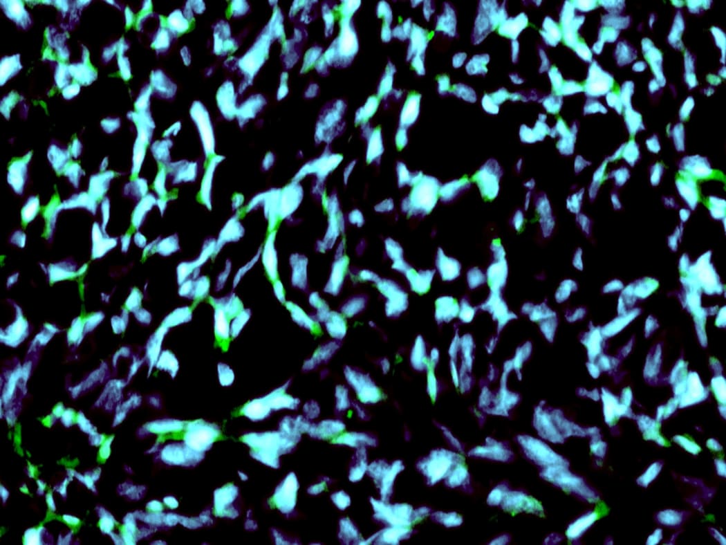 Nanoparticles in Glioma Cell Nuclei