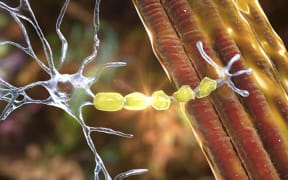 Demyelination of neuron, the damage of the neuron myelin sheath seen in demyelinating diseases, such as multiple sclerosis and other demyelinating myelinoclastic and leukodystrophic diseases, computer illustration.