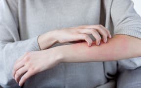 Stock image of a person scratching their arm.