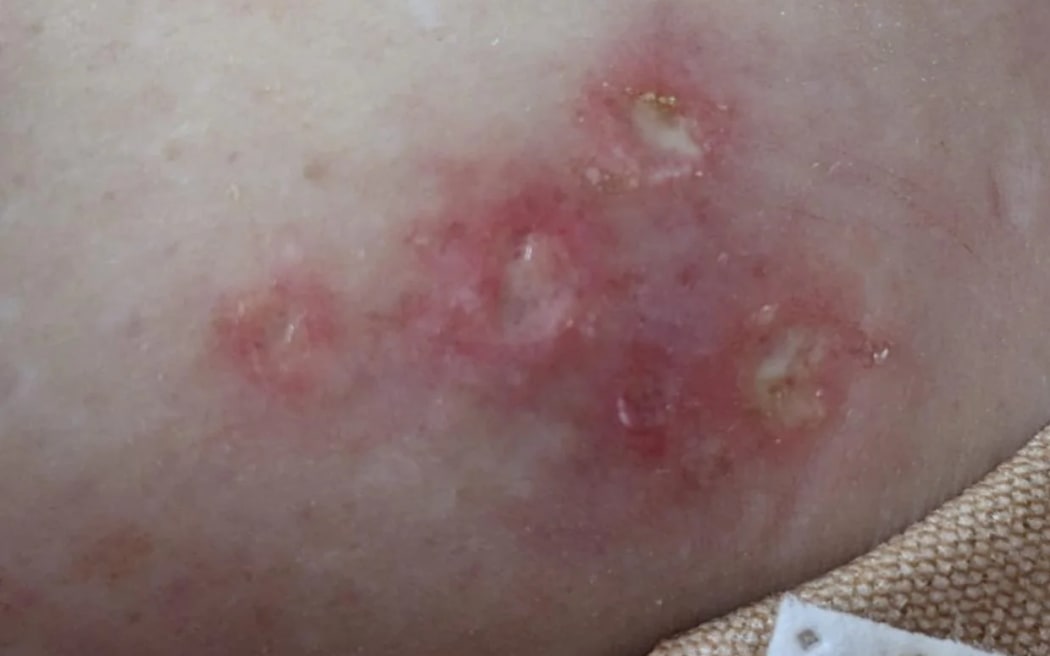 One of the rashes Sarah experienced which she says was caused by glass fibres from her mattress.