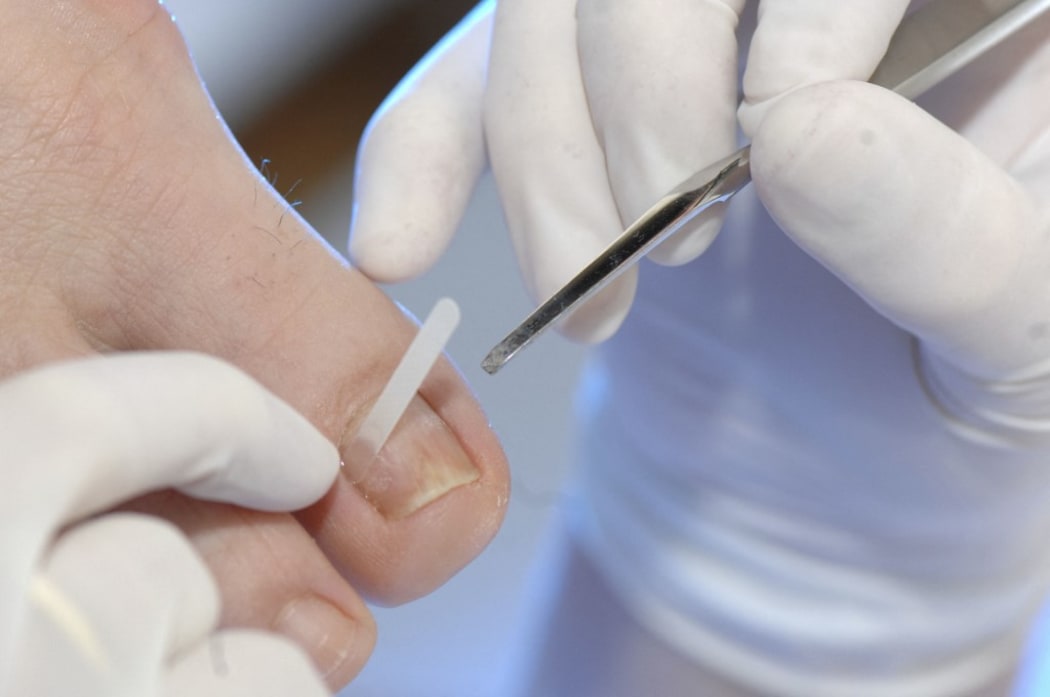 PEDICURE 
Photo essay from health professional's office. Photo essay in a podiatry surgery. Cares of podiatry. Orthonyxia placement of a strip on the nail to correct the curve. 

JOSE OTO / BSIP (Photo by JOSE OTO / BSIP / BSIP via AFP)