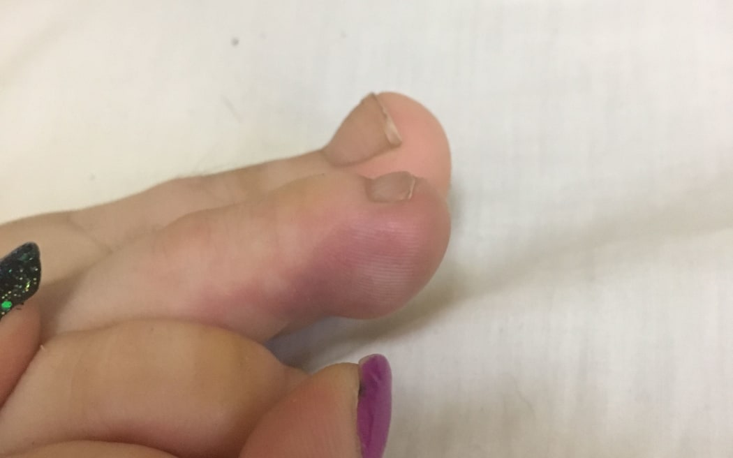 Suzanne Insley's toe, where the pain began in January 2018.