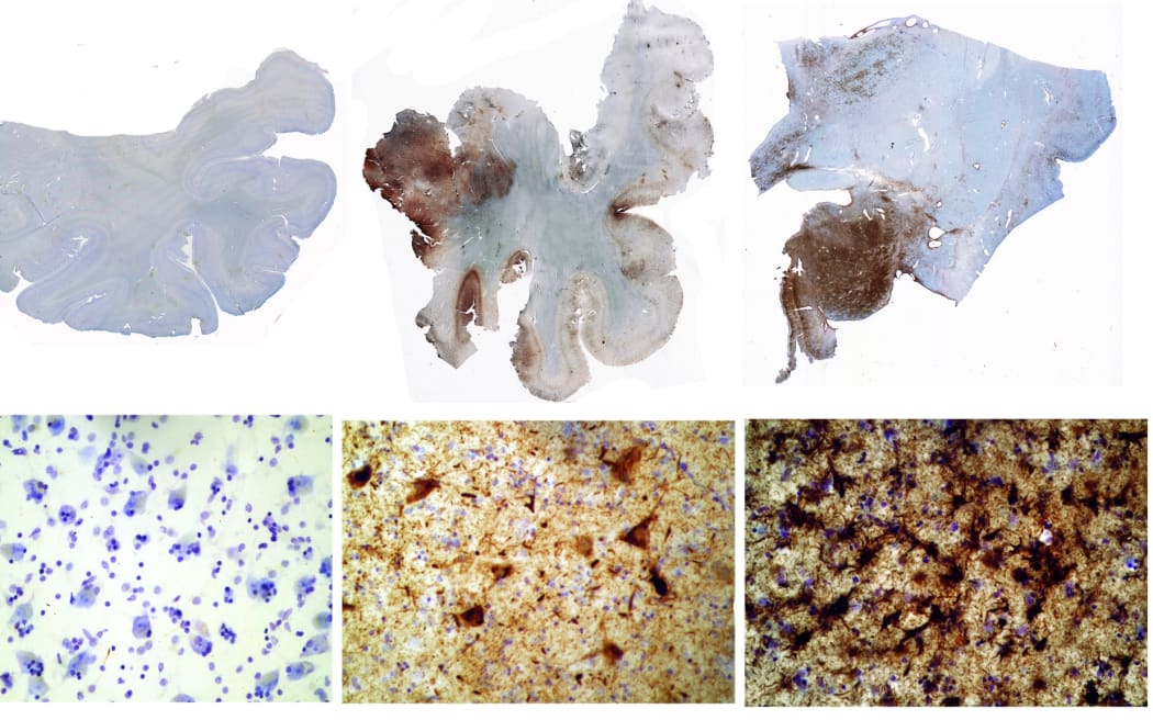 These brain sections show unusual concentrations of theTau protein, shown here as brown spots. The more brown spots, the greater the brain damage. From L-R: A normal brain of a 65 year old, the brain of a football player, who suffered eight concussions and died aged 45; the brain of a 73 year old boxer who suffered from an extreme form of dementia pugilistica.