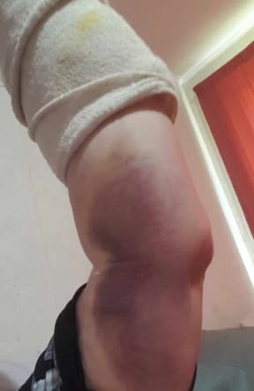 Prison officer Sharon Irwin's arm was so badly broken at work that she required surgery. SINGLE USE IMAGE.