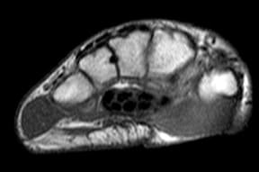 An MRI image of a cross section of a hand