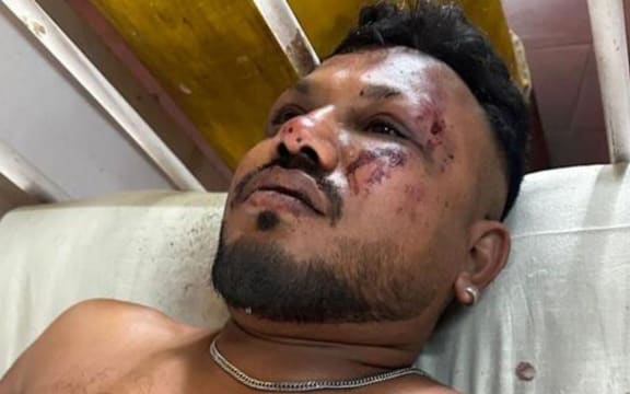 Vishwash Kumar Ramesh - survivor of Air India crash - single use only
