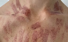 A Wellington woman has been left with burn marks all over her chest from an IPL treatment on 8 February 2024 (for use with this story ONLY).