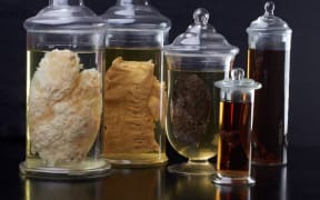 Organ specimens that actually caused the patient to die, including a liver slice riddled with metastatic melanoma