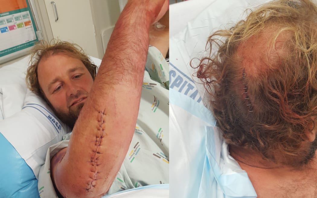 The injuries suffered by the diver run over by an Auckland boatie.
