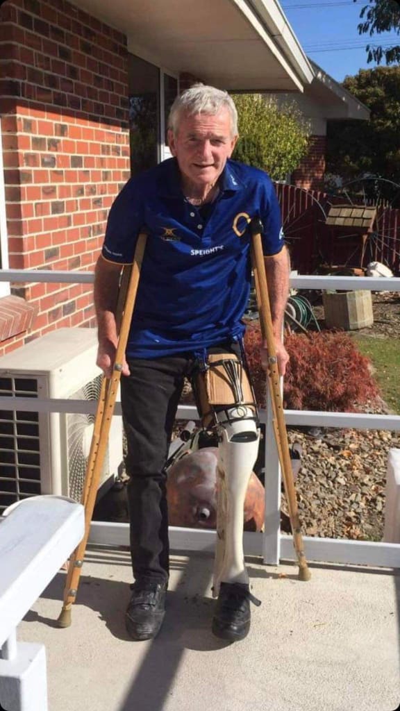 Alan Keith Nicholl with his home-made prosthetic leg.