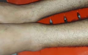 The swollen left ankle of Azzam el Sheikh.