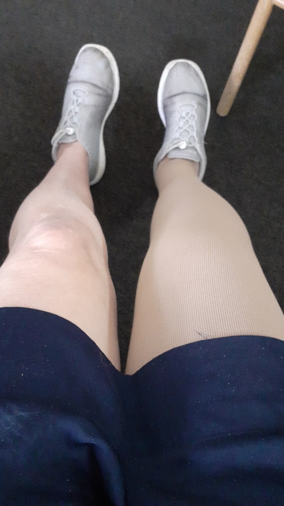 Melanoma survivor Joyanne Lovatt who developed lymphoedema - legs after surgery