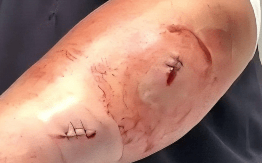Stab wounds on Mary's arm.