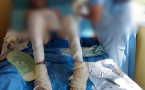 SARV victim: An elderly woman who died of complications later. 