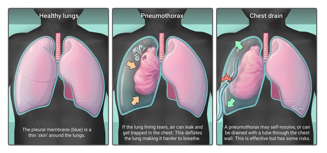 Pneumothorax vs drain diagram