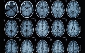 health medical image of an mri of the head showing the brain. Magnetic resonance image.