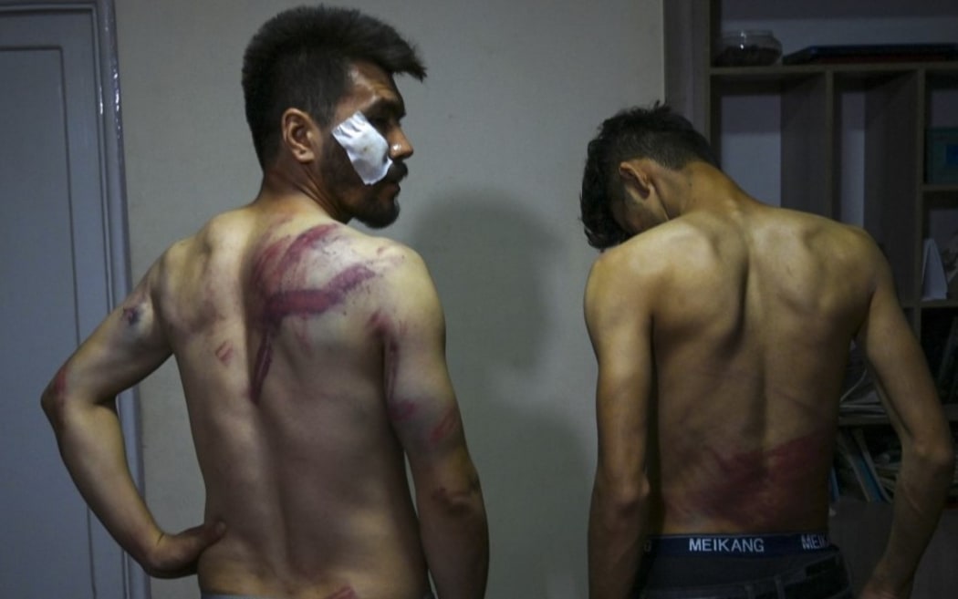 In this picture taken on September 8, 2021, Afghan newspaper Etilaat Roz journalists Nematullah  Naqdi (L) and Taqi Daryabi show their wounds in their office in Kabul after being released from Taliban custody.