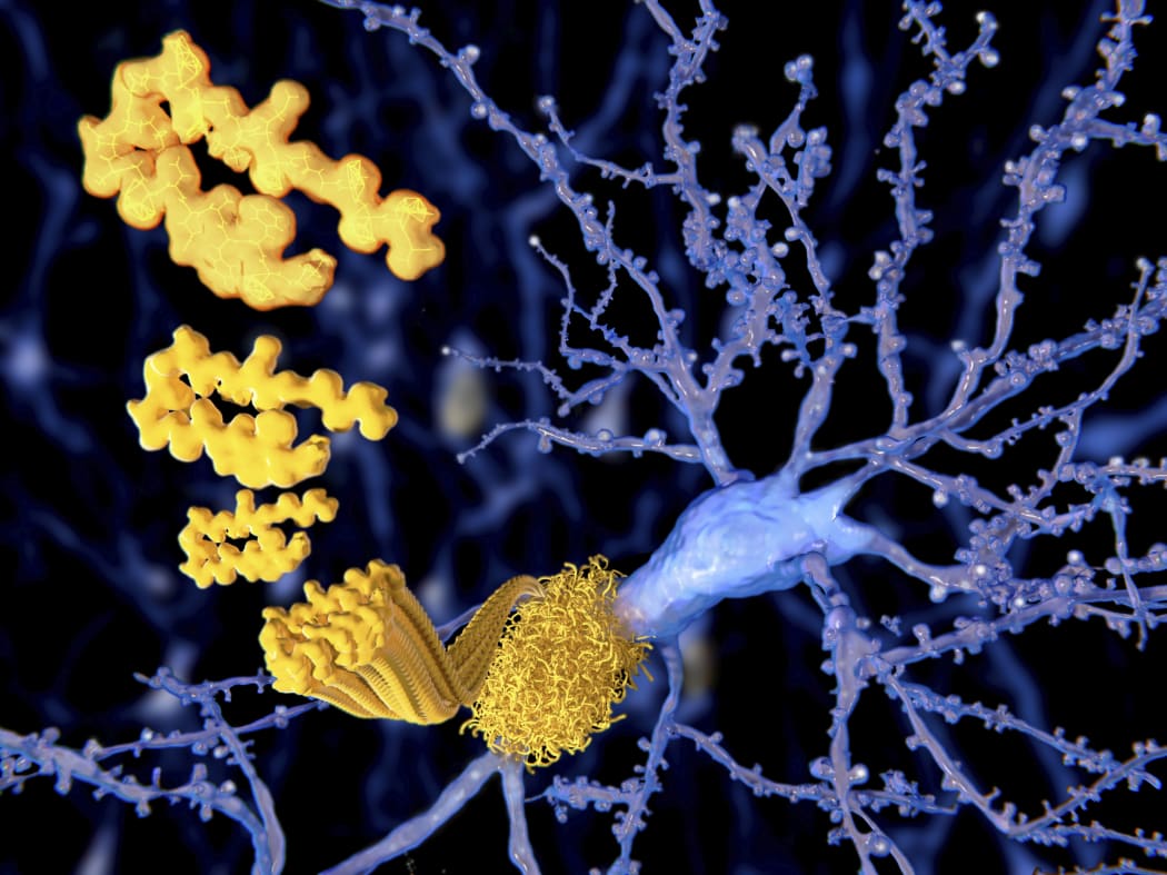 Amyloid beta peptide, computer illustration. This protein is the primary component of amyloid plagues in the brains of Alzheimer's patients.