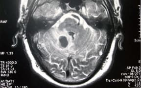 Stroke in MRI