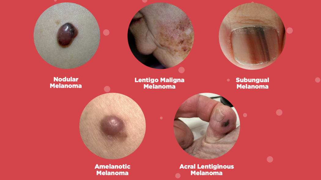 melanoma