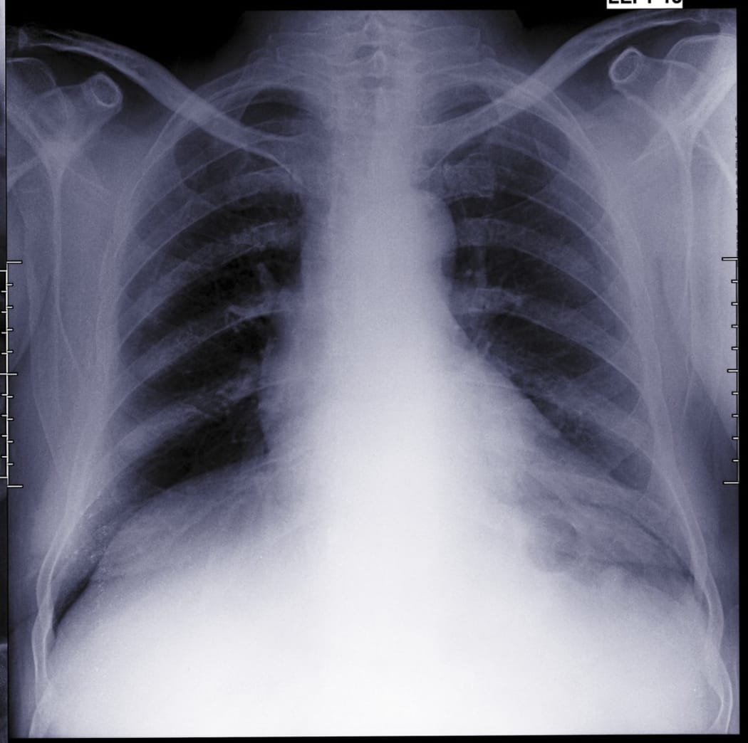 Chest, X-ray. (Photo by NICK VEASEY/SCIENCE PHOTO LIBRAR / NVY / Science Photo Library via AFP)
